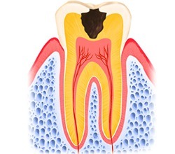 C2　象牙質の虫歯