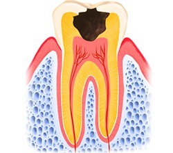 C3　神経に達した虫歯