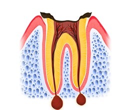 C4　歯根に達した虫歯